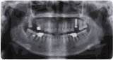 Panoramic X-ray