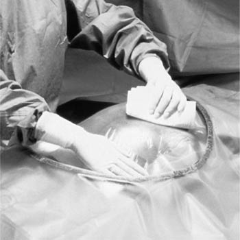 3M™ Steri-Drape™ Cesarean-Section Sheets & Pouches with Loban 2 Incise Film, 35" x 30"